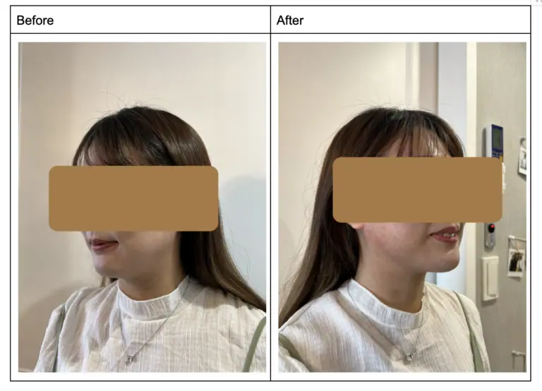 2024真實見證｜Decoy非侵入消除雙下巴，無痛立即有感！（有圖）